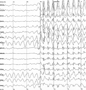 Epileptic spike and wave discharges monitored EEG - a bunch of squiggly lines